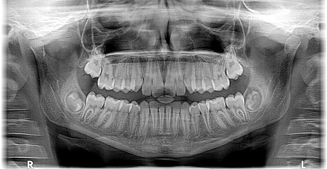 Zdjęcie rentgenowskie szczęki — kiedy należy je wykonać?